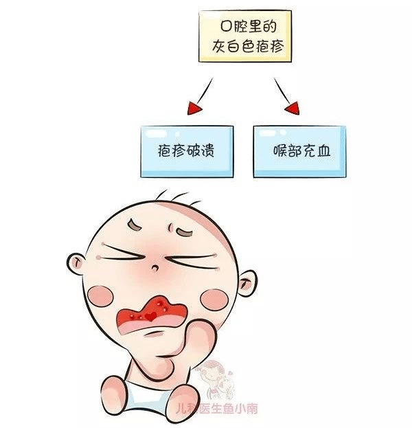 疱疹性咽峡炎经医生诊断,这些孩子是得了这是喉咙发炎么?怎么办呀!