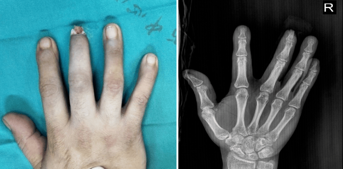远节指骨外露,远侧指间关节活动受限 ,诊断为"右中指远节软组织