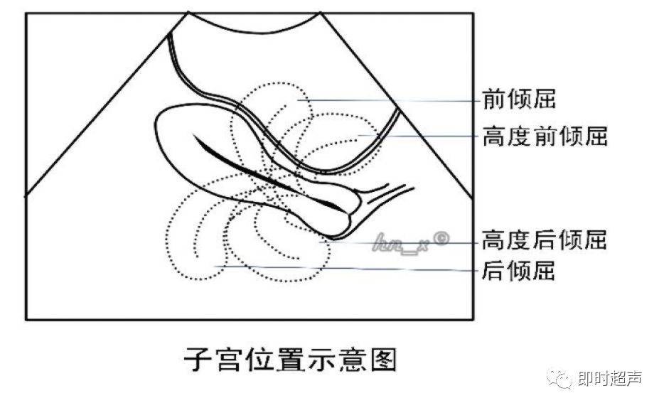 根据宫颈与宫体的位置关系可以判断子宫的倾屈程度,宫体与宫颈的纵轴