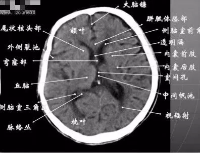 四叠体池: 两侧枕叶之间,池内有松果体,向前与第三脑室连接.