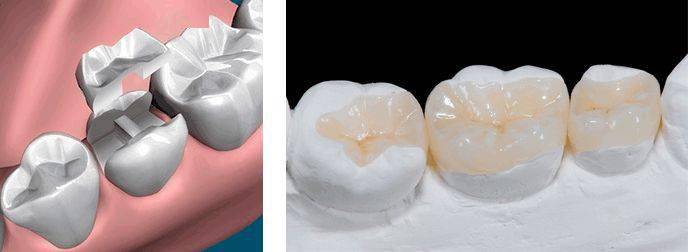 为什么有的补牙需要选嵌体,细说嵌体的作用_牙齿_口腔