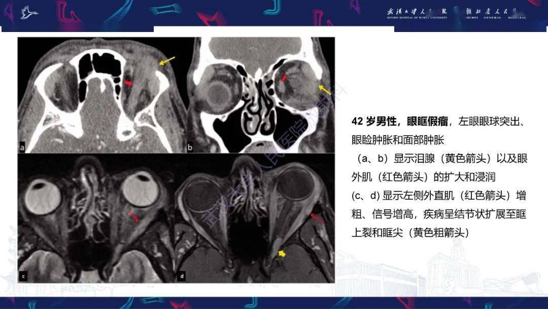 眶尖疾病影像诊断