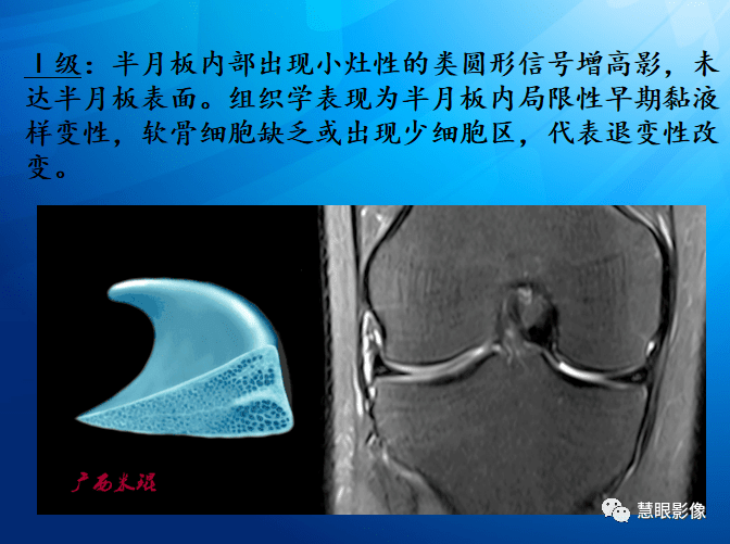 mri半月板损伤基础