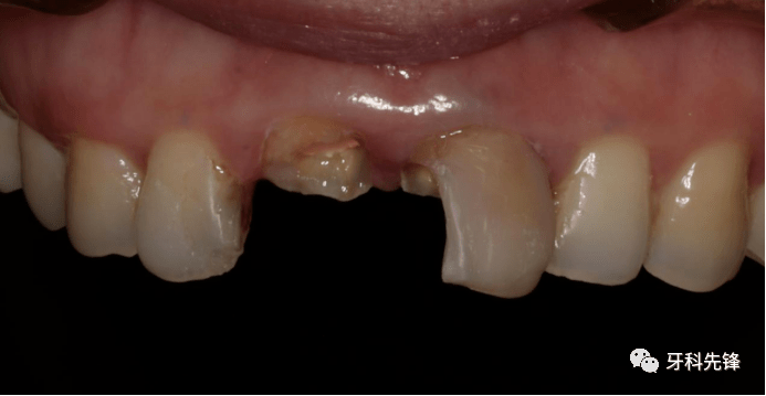 21严重龋坏,11多年前桩核冠修复,因咬硬物导致牙齿劈裂,牙体严重缺损