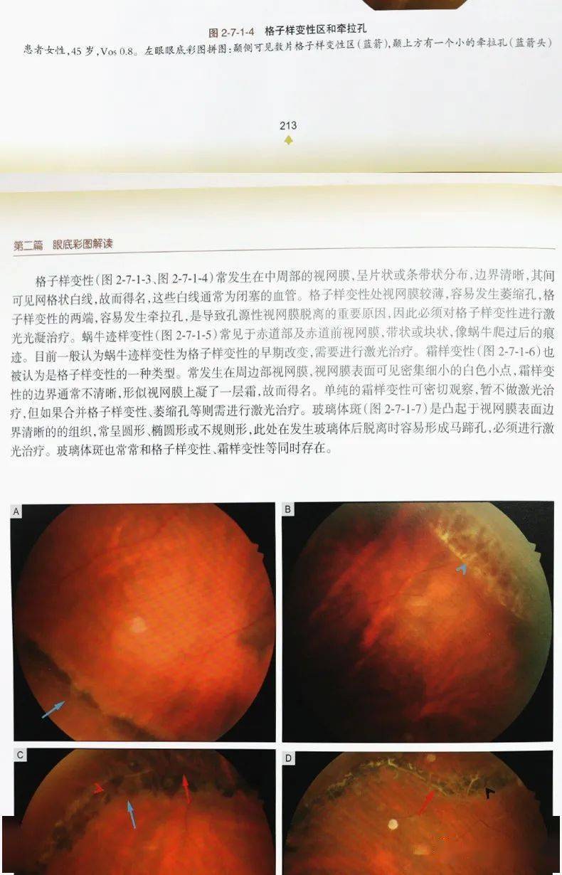 常见眼科病例的眼底照片集锦_视网膜_变性_黄斑