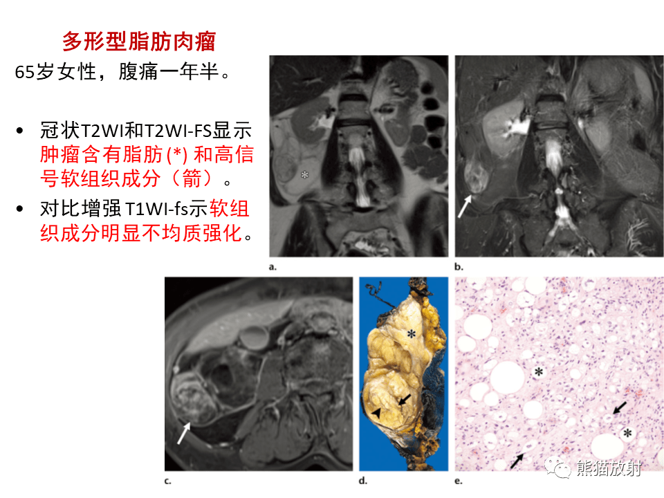 【省立影像读片】腹膜后肿瘤 21.12_内容_副神经_搜索