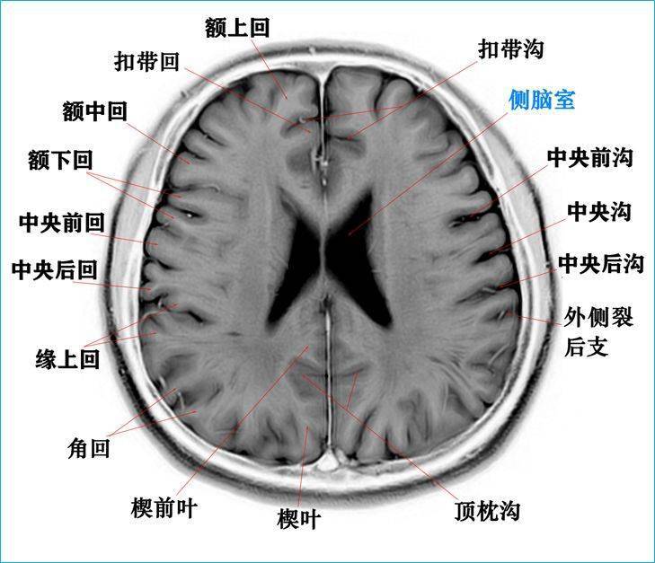 利用t2wi反相图学习高清颅脑断层解剖