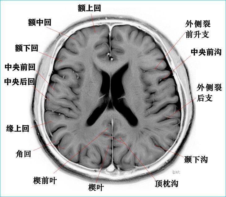 利用t2wi反相图学习高清颅脑断层解剖