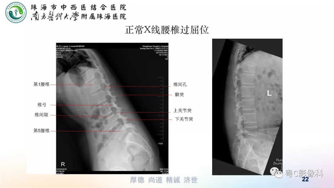 医影技术丨腰椎六位片摄影技术正侧位双斜位过伸过屈位