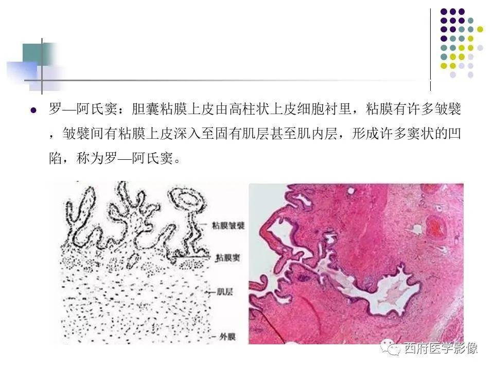 黄色肉芽肿性胆囊炎