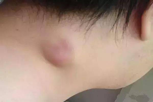 这些小疙瘩暗示肿瘤来临,赶紧看看!_国家癌症中心