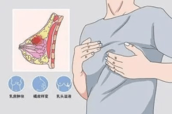 什么是乳腺癌?