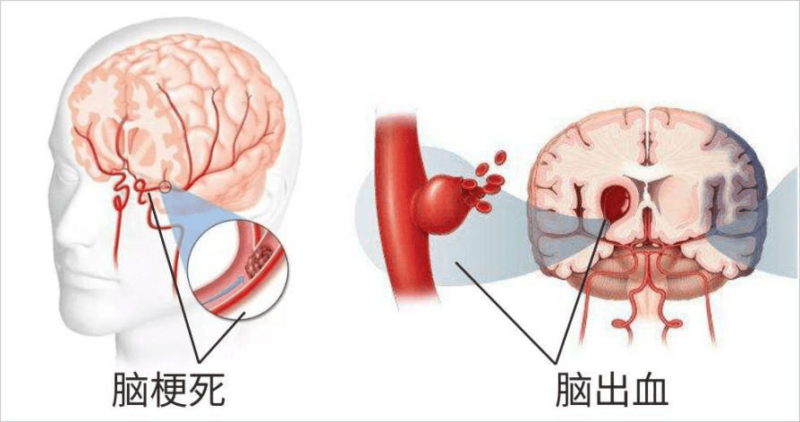 脑血管造影你了解吗