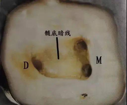 【总结】根管口定位法则和探查遗漏根管的一些数据_远中_下颌_治疗