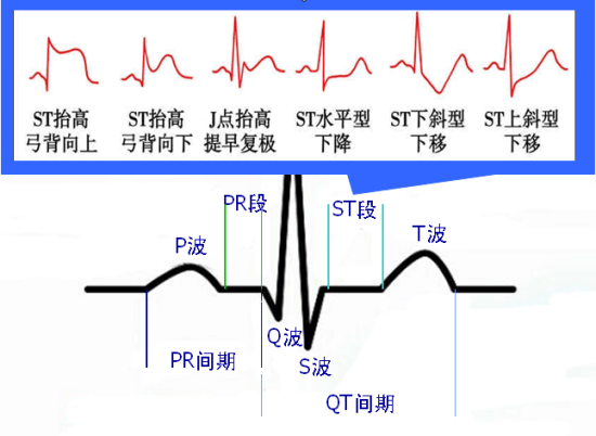 冠心病的鉴别与诊断_心电图_心肌_病理性