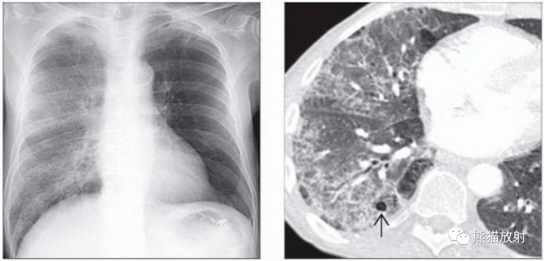 肺孢子菌肺炎卡肺肺寄生虫病丨影像表现