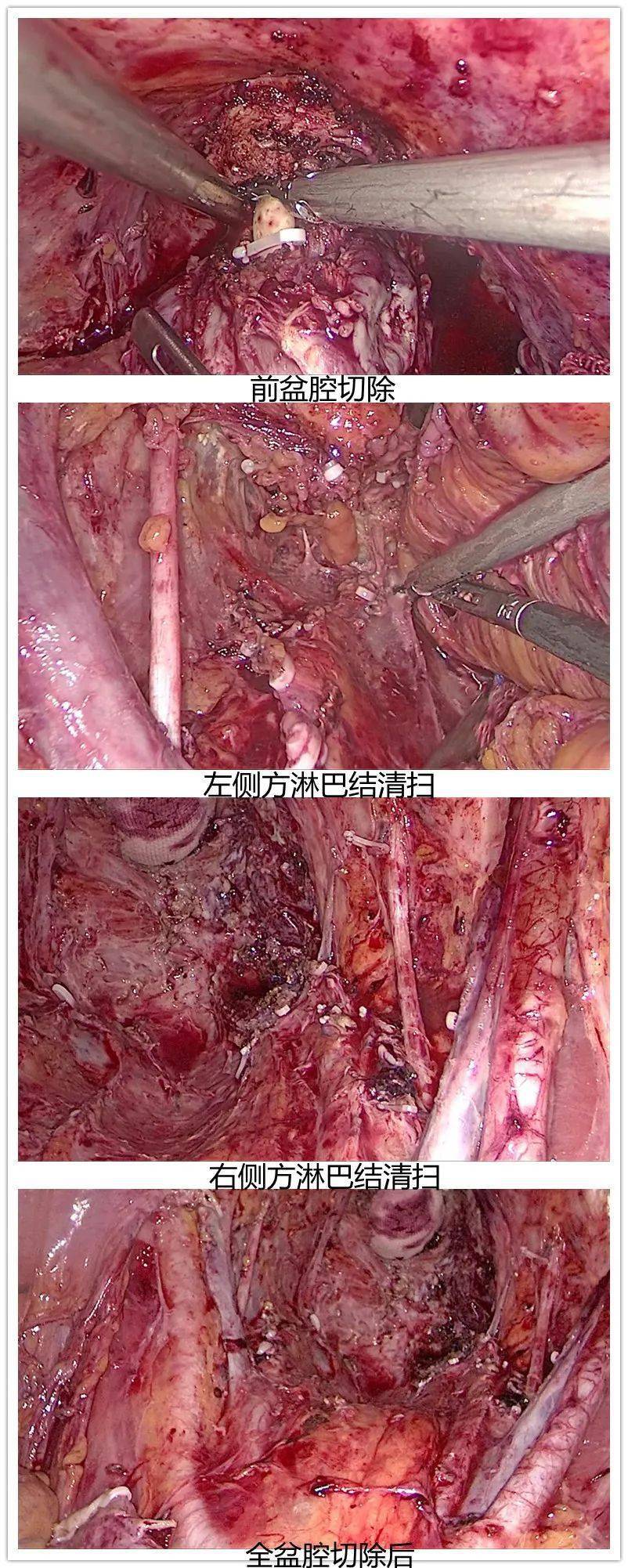 分别切开左右侧盆侧腹膜,清扫髂外动静脉,髂内动静脉周围淋巴结,清扫