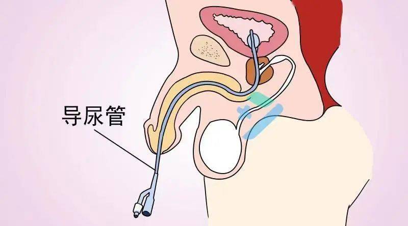 患者插了尿管怎么还会漏尿呢原因竟然是