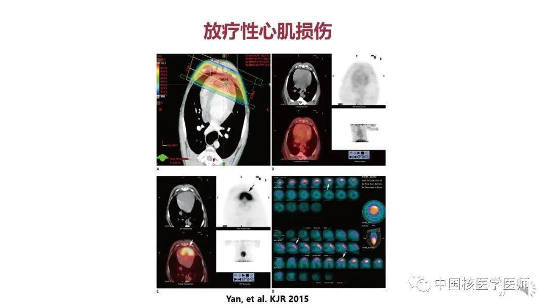 【核汇园】67期:杨敏福教授 fdg心血管显像的拓