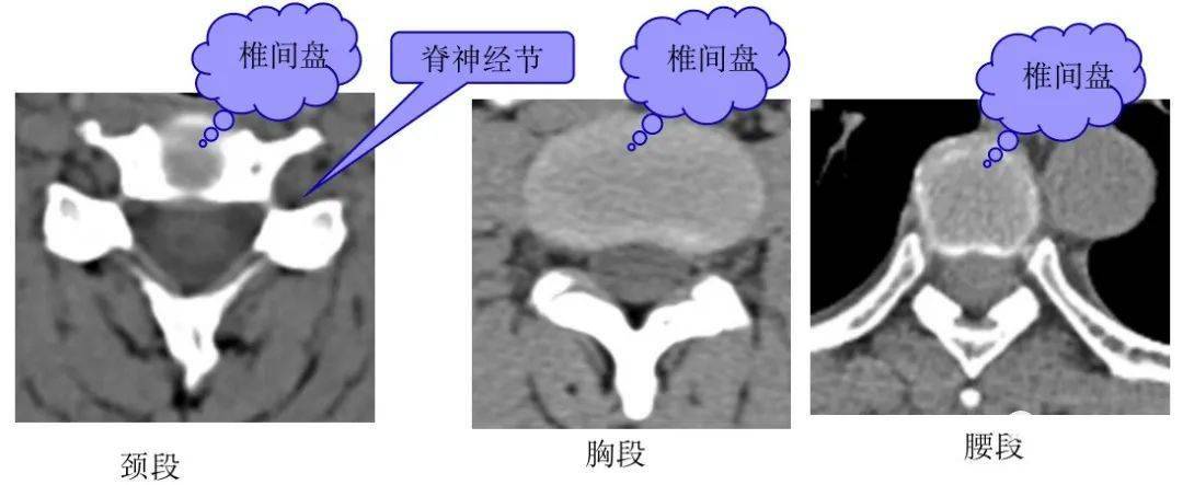 椎内静脉丛:位于硬膜外间隙内,在ct平扫上不能单独显示,增强扫描呈