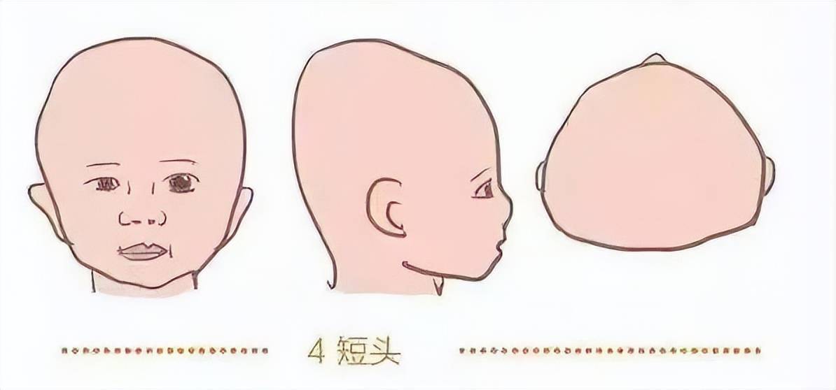 新生儿这个病被耽误到3岁,不得不做开颅手术_可可_头型_宝宝