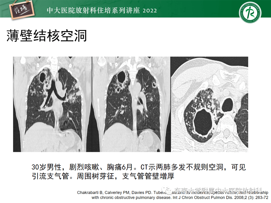 肺空腔,空洞性病变诊断分析思路_解剖图_全网_影像