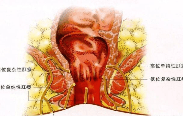 3,肛周瘙痒当外口愈合,瘘管中有脓肿形成时,可感到明显疼痛,同时可