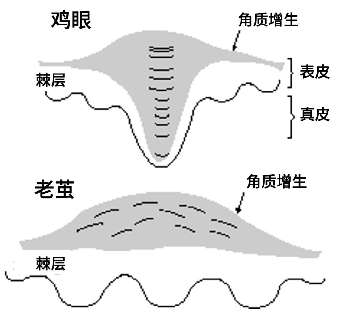 一,老茧和鸡眼有什么区别?