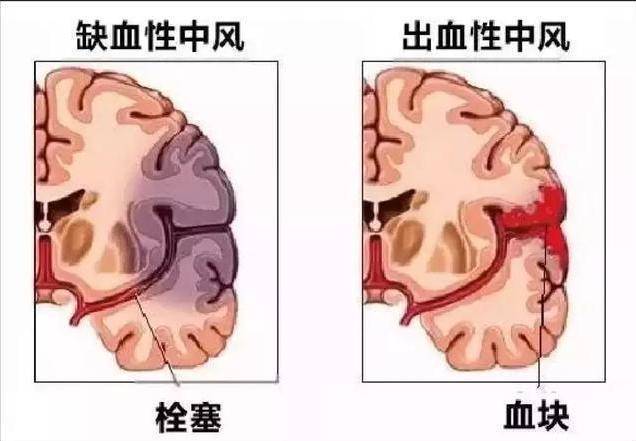 脑梗是“拖”出来的吗？睡觉时若有这3个现象，或要引起重视