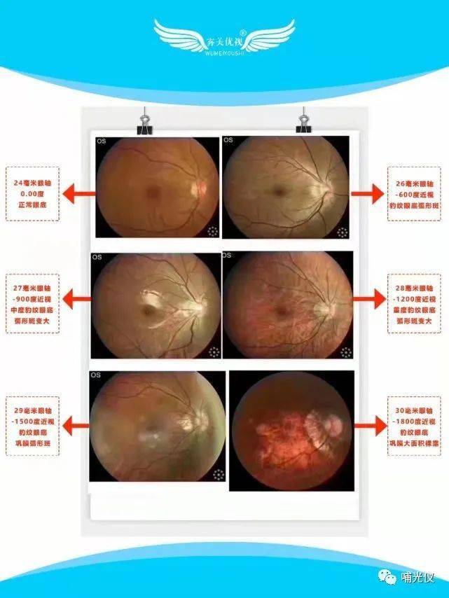 孩子近视能用感光仪吗？