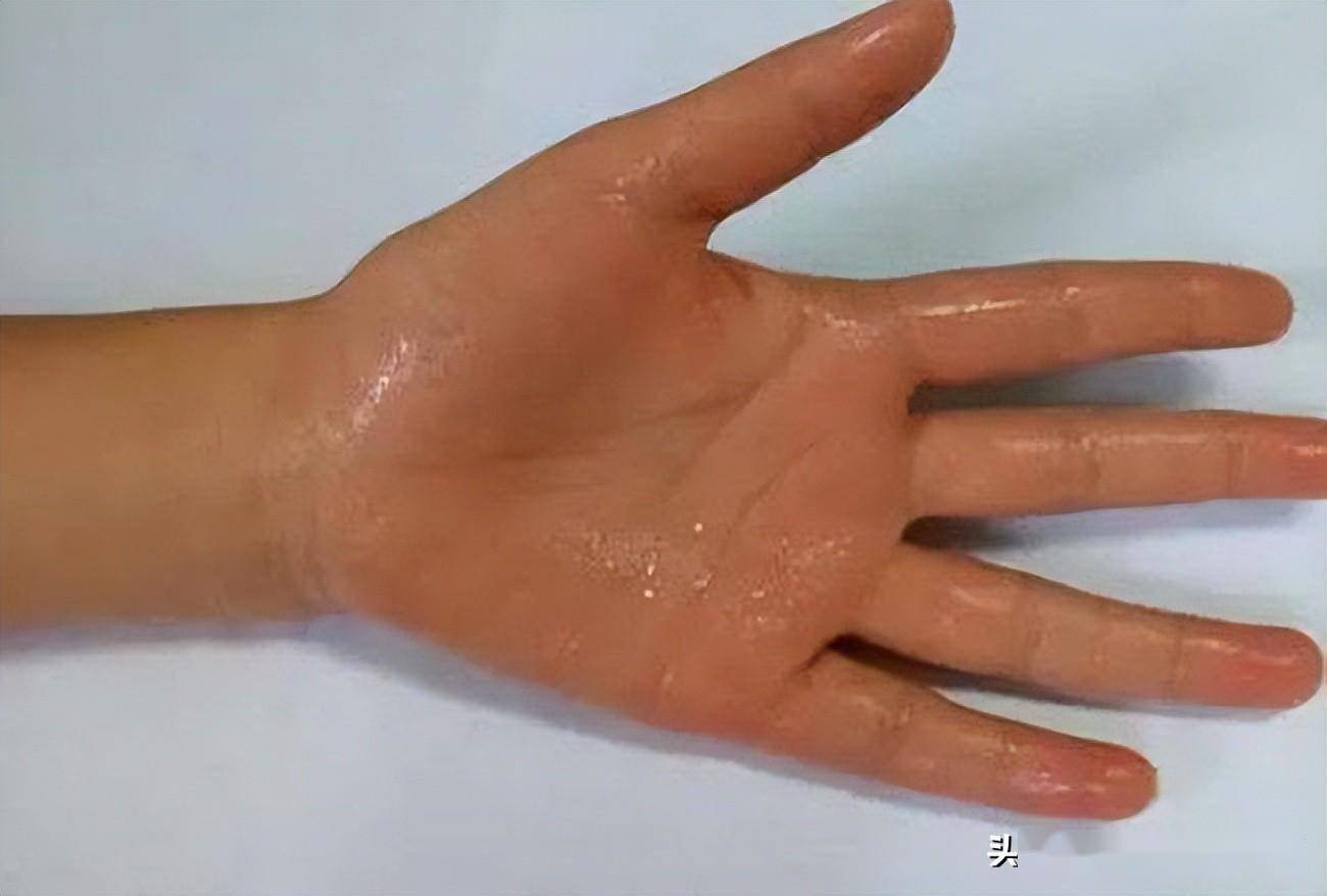 手心经常出汗是怎么回事？可能和5个因素有关，给您5个思路参考