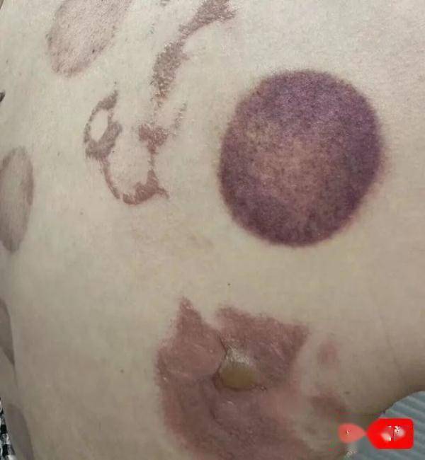 绍兴知名足浴店，女子拔罐出事了