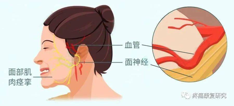面肌痉挛的发病机制及临床治疗
