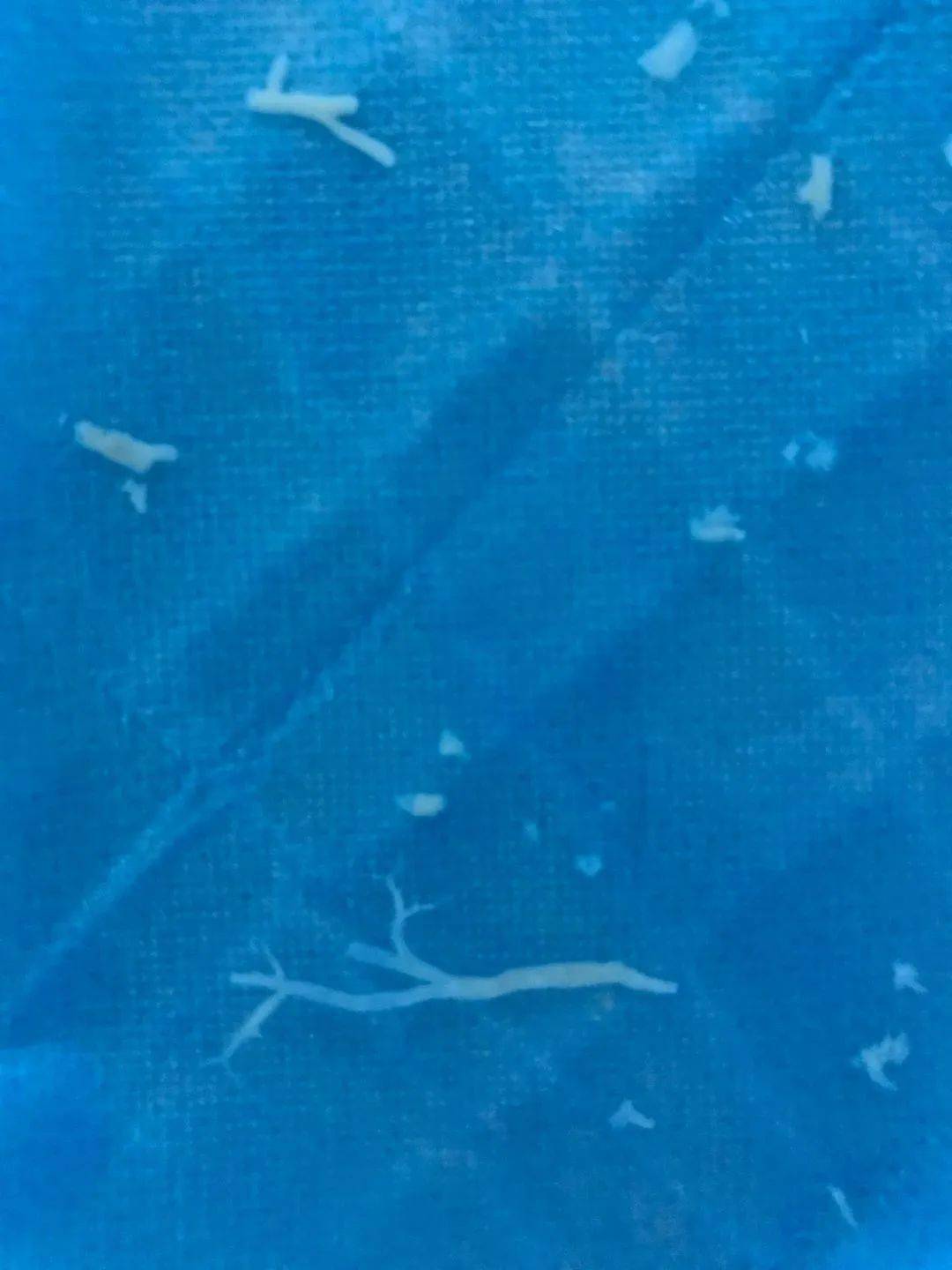 开口都是被痰栓这种内生异物堵住，深部更细小的支气管也是堵塞的状态。医生花费了70分钟从女孩的左肺支气