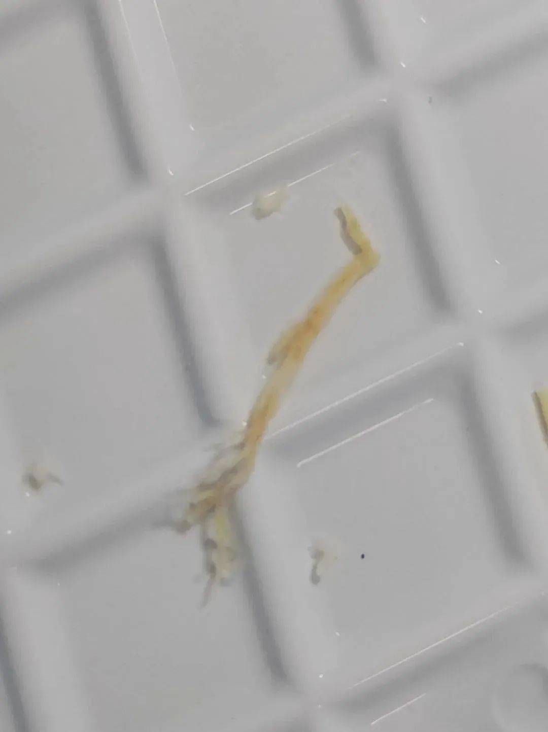 开口都是被痰栓这种内生异物堵住，深部更细小的支气管也是堵塞的状态。