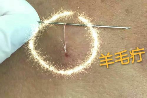 中医培训王合民民间绝技挑羊毛疔治疗心慌胸闷