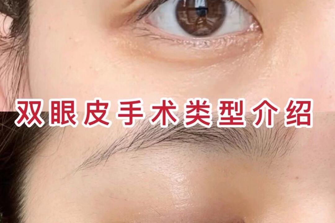 双眼皮手术类型