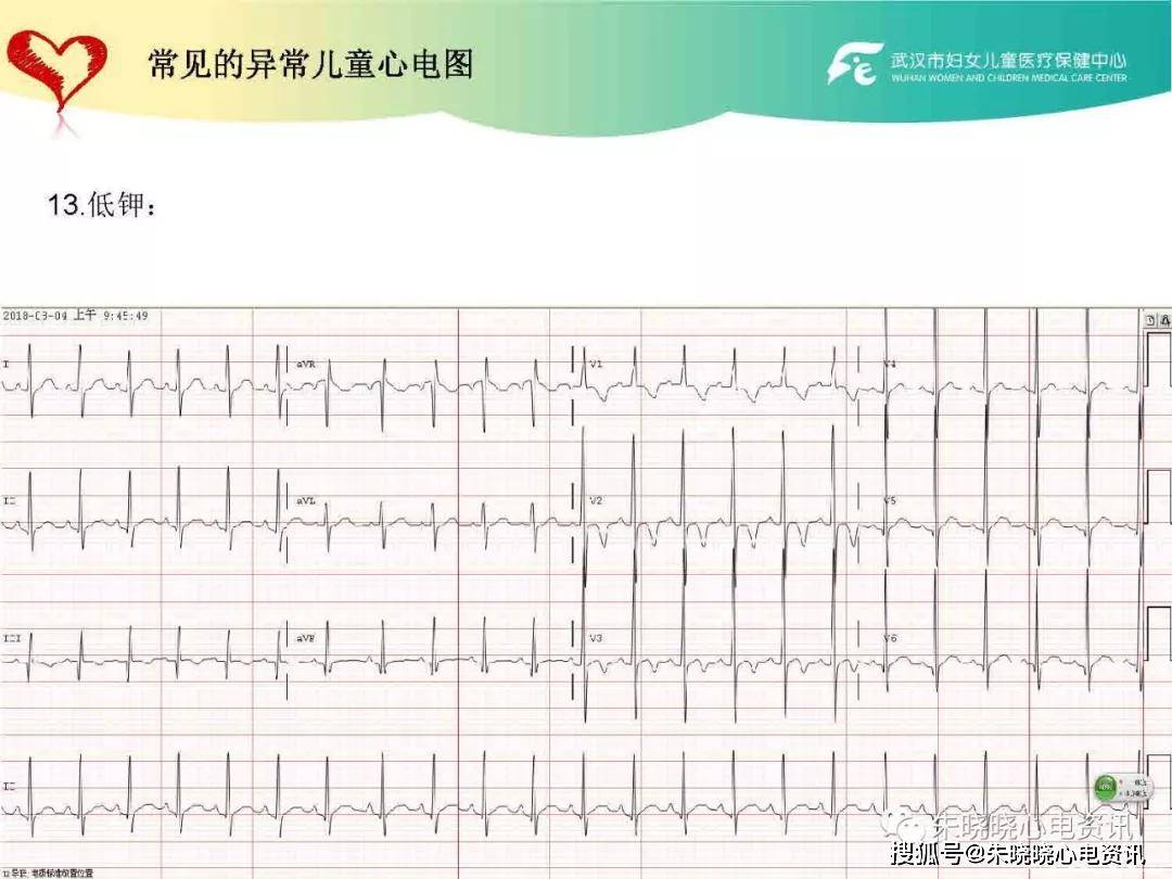 儿童心电图