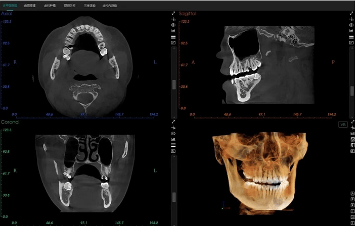这台有"ai"的口腔cbct来了!
