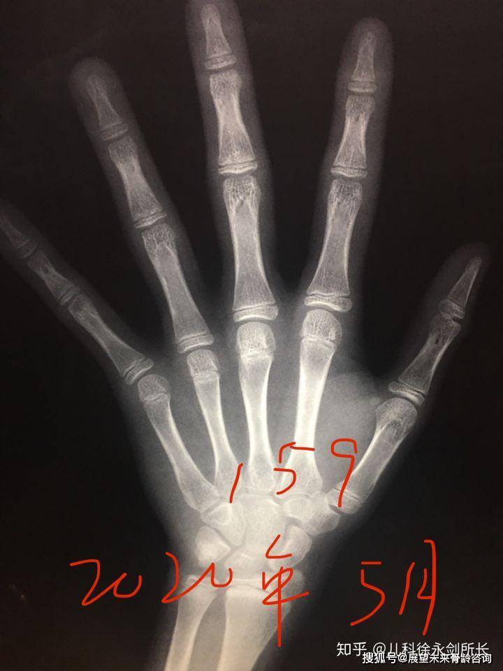 7岁骨龄,159基数据预测未来身高171至177.