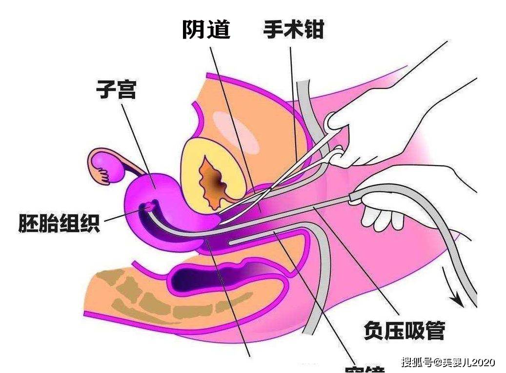 泸州女子婚前检查出有人流史