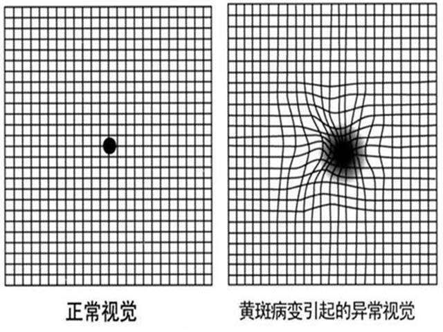 眼底病变自测图图片