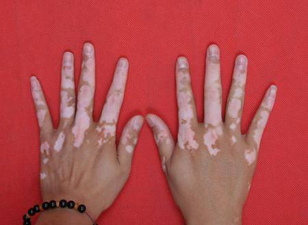 白色胎记: 在医学上称之为色素脱失斑,一般轮廓呈椭圆形,形状不规 ..