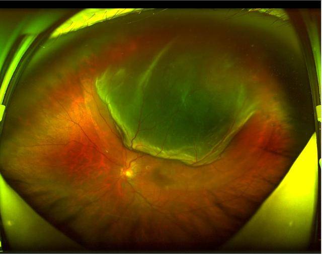 孔源性视网膜脱离新治疗:球周顶压球囊!爱尔集团唐仕波亲自操刀