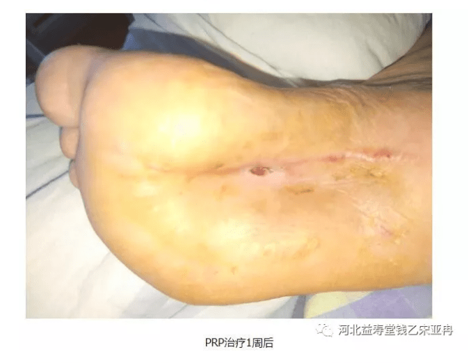 骨与关节疾病治疗新途径(病例分享)