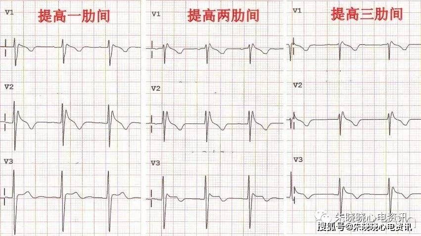 心电图顺钟向转位图片