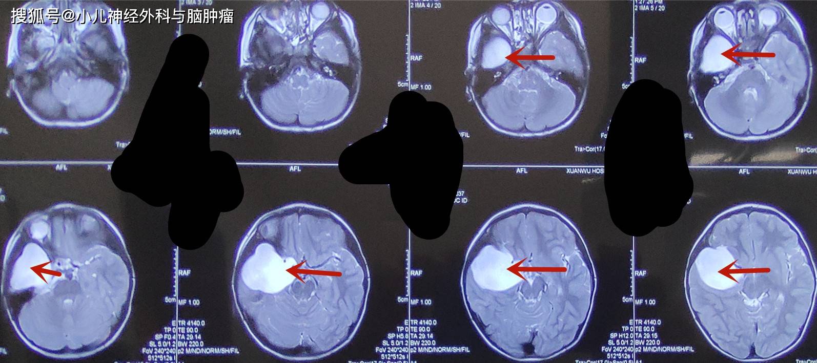 孩子的家长讲,小孩子出生不久就在做ct的过程中发现了颅内蛛网膜囊肿