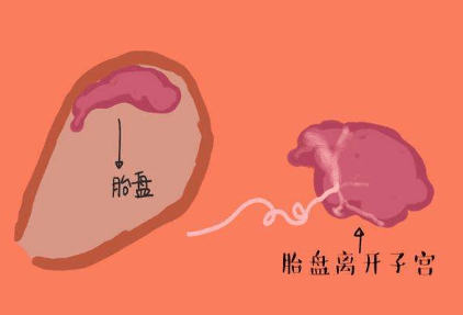 哪些孕妇容易遭遇手剥胎盘?