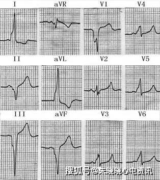 第八章心室预激的心电图诊断