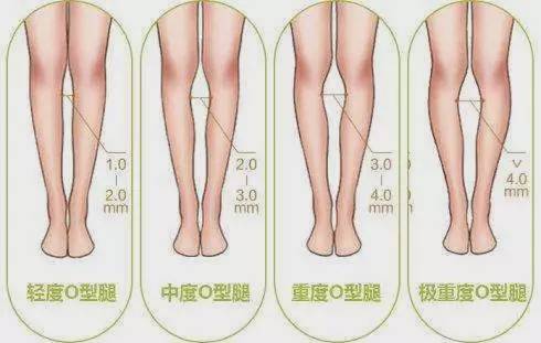 o型腿测量标准图图片